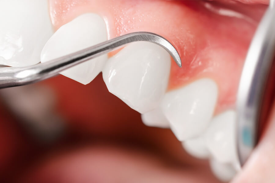 歯と歯肉の間に溜まっていた歯石や歯垢（プラーク）除去